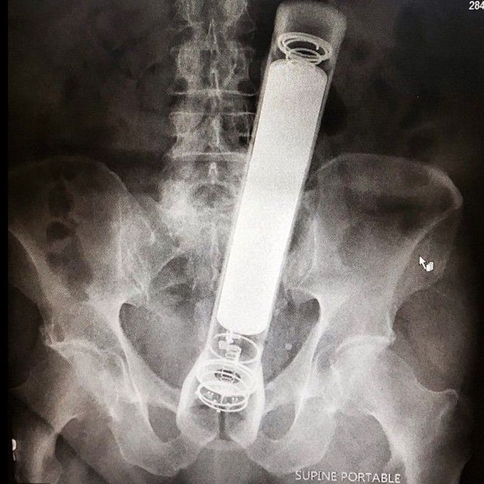 Foreign body xray