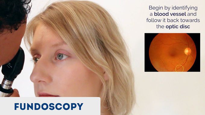 Fundoscopy (Ophthalmoscopy) - OSCE Guide