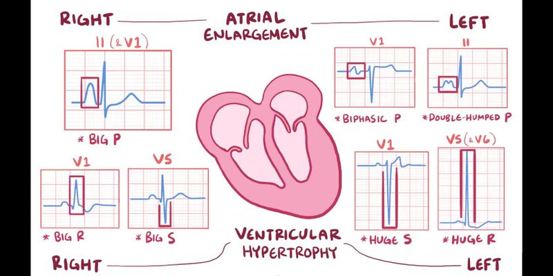 Hypertrophy of heart - MEDizzy