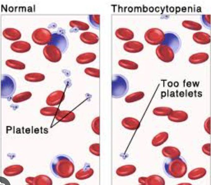 Cause of Thrombocytopenia