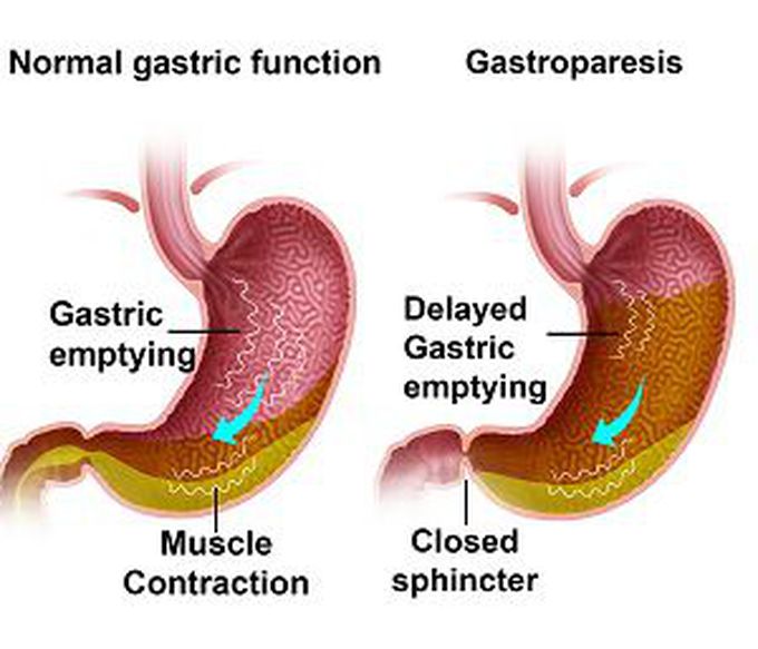 Gastroparesis