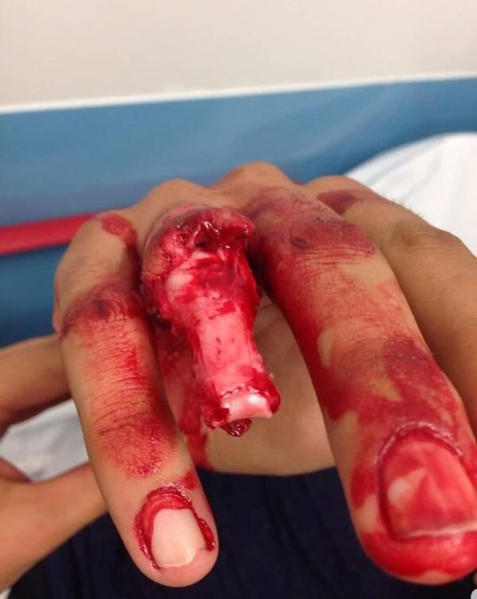 Finger degloving