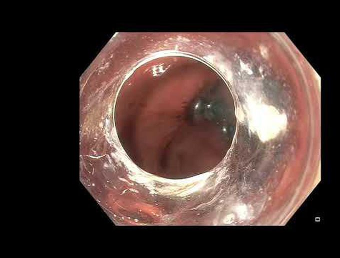 Hybrid Endoscopic-Laparoscopic Transgastric Resection of Gastric Subepithelial Tumor