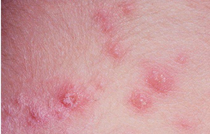 Varicella