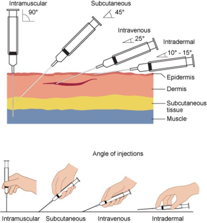 DIFFERENT TYPES OF INJECTION