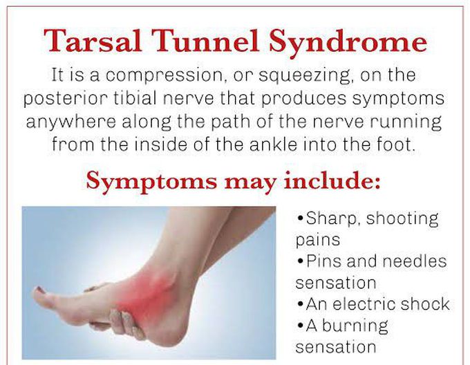 These are the symptoms of Tarsel Tunnel syndrome