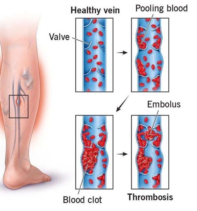 Healthy Vein Vs Thrombosis