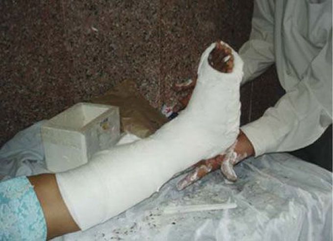 Plaster of Paris Disease