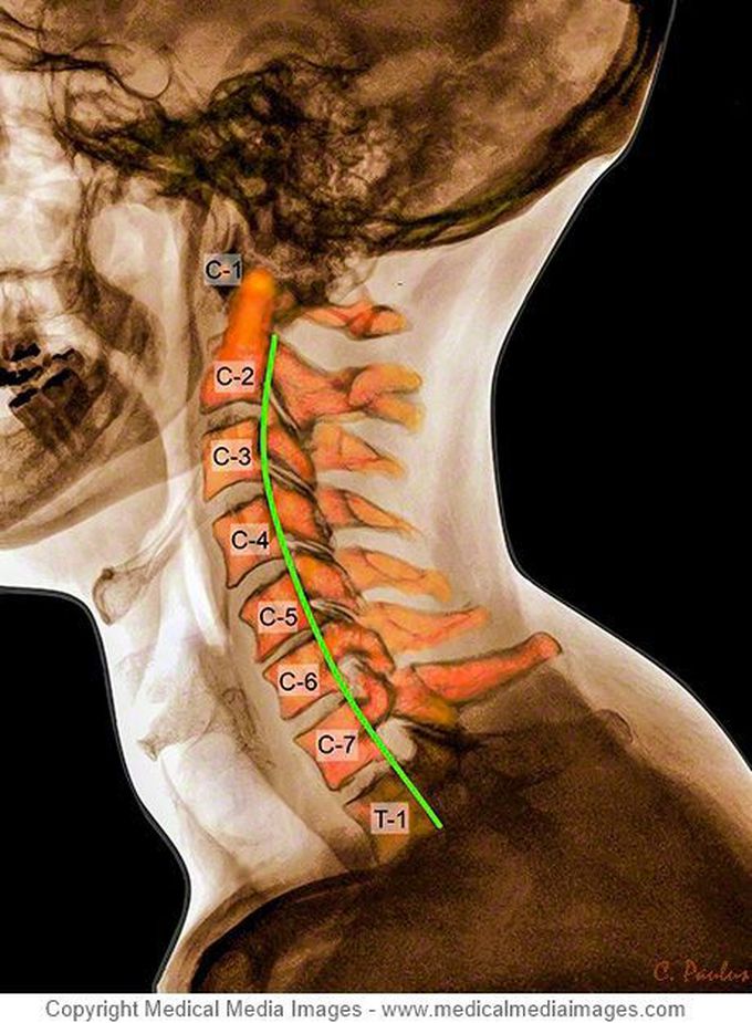 Color X-Ray and Color MRI of the Cervical Spine