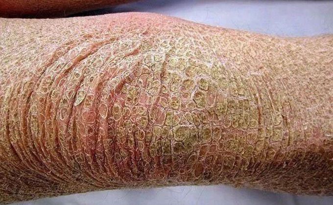 Lamellar Ichthyosis