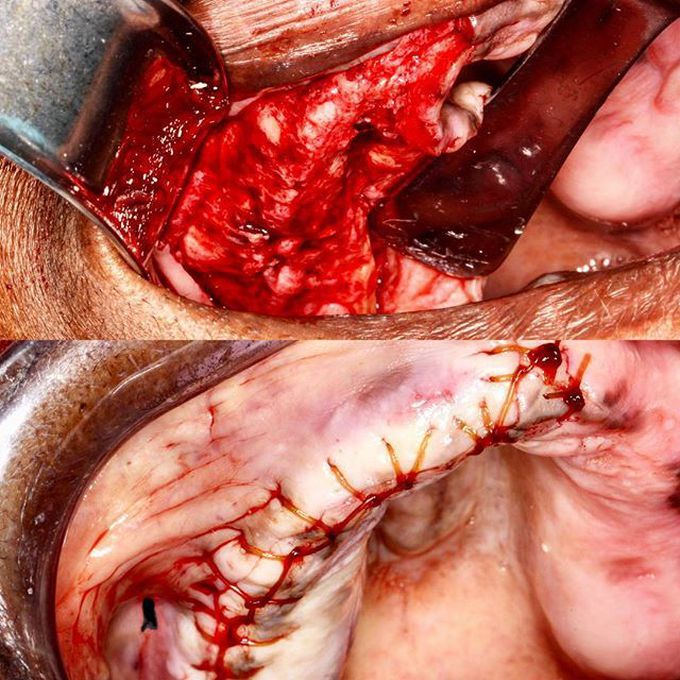 Maxillary alveoplasty to correct irregular morphology of the alveolar ridge 👨‍⚕️👌💪 