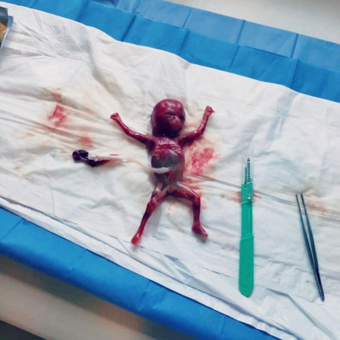 Here is an unfortunate case of a spontaneous miscarriage of a 14 weeks fetus