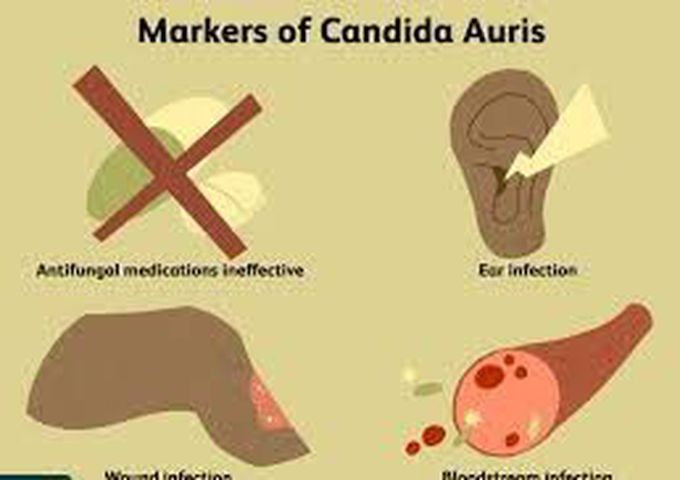 Symptoms of candidiasis