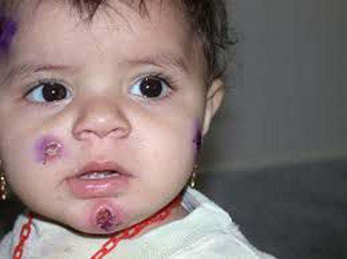 What is leishmaniasis