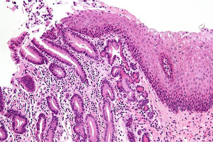 Metaplasia