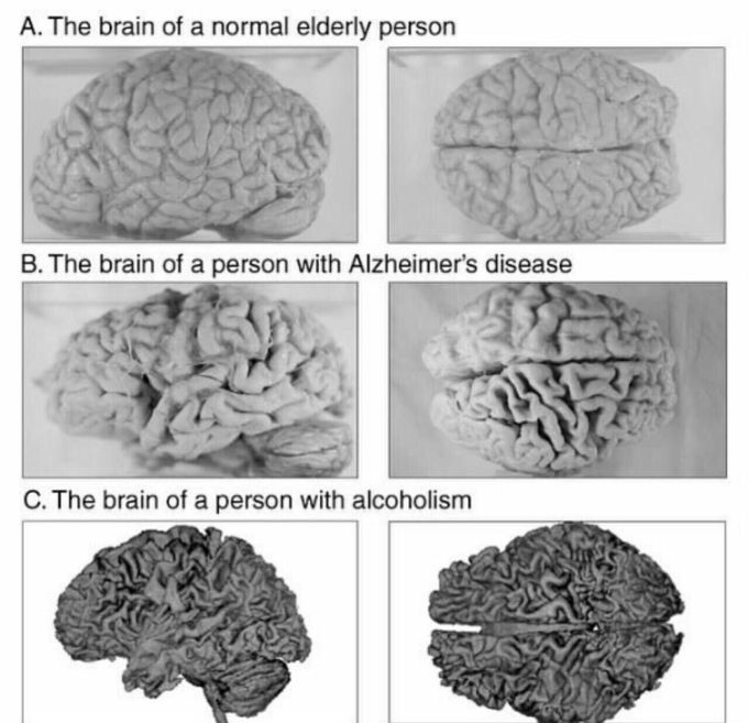 Brain