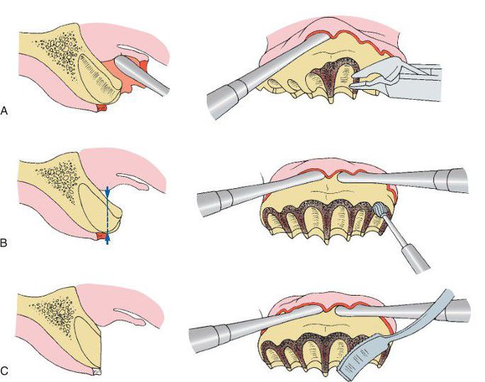 Simple alveoloplasty