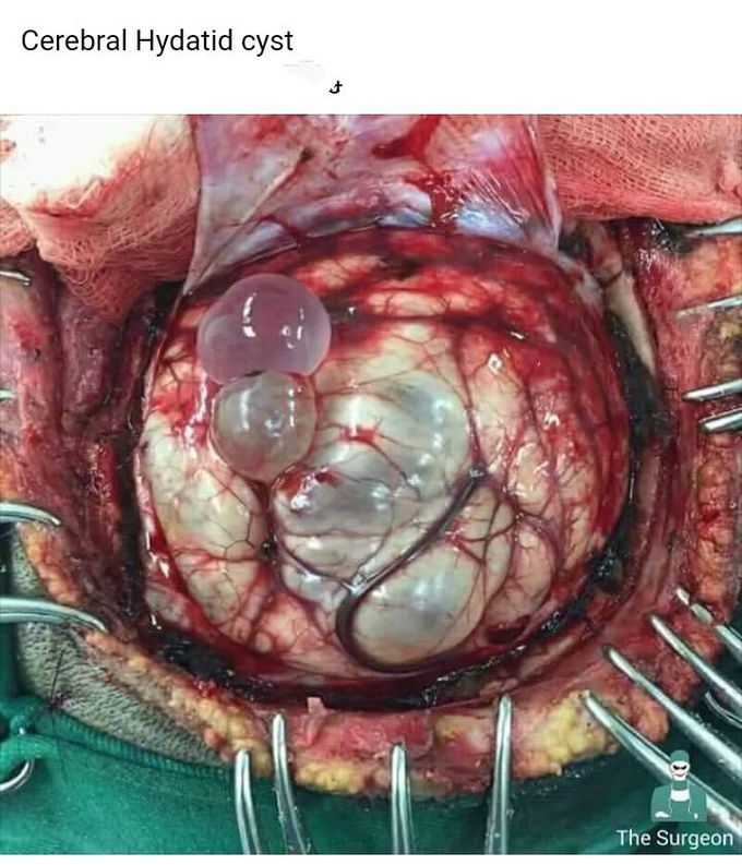 Cerebral Hydatid Cyst