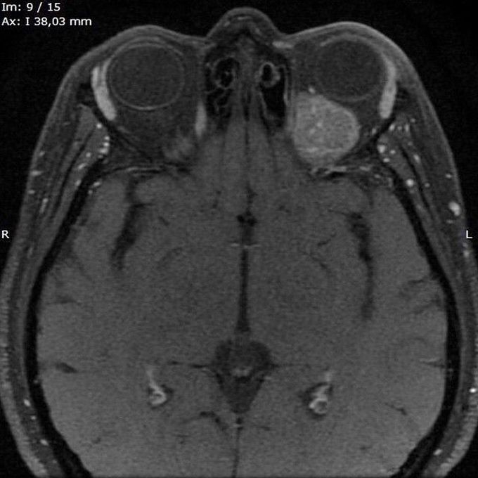 The MRI of a patient with retro-orbital melanoma metastasis!