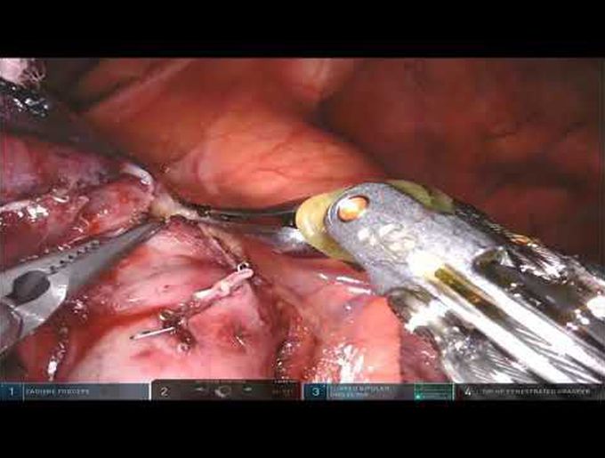 Robotic-Assisted Left Upper Lobectomy in Non-Small Cell Lung Cancer With N1 Disease