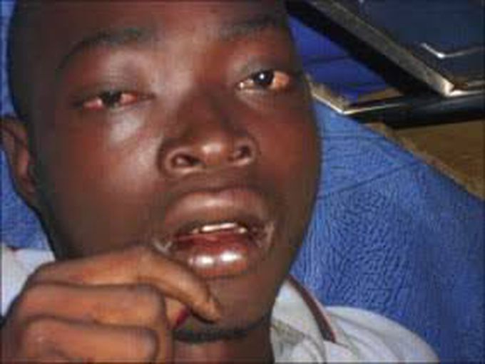 Symptoms of Lassa fever