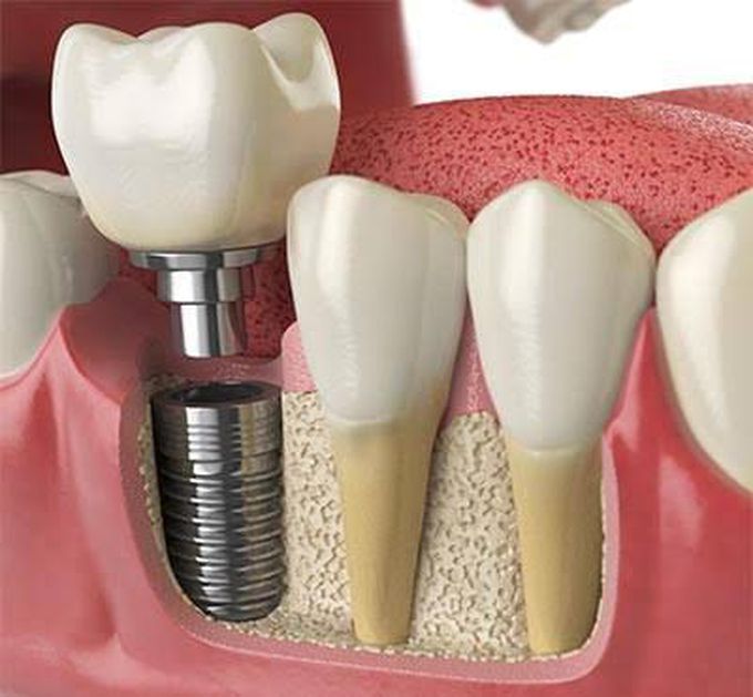 Contraindications for dental implants are?