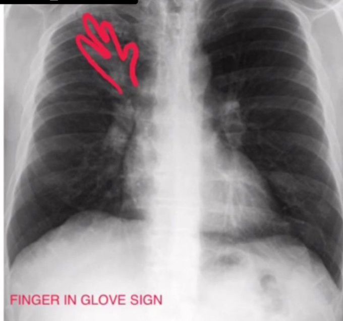 Finger in Glove Sign
