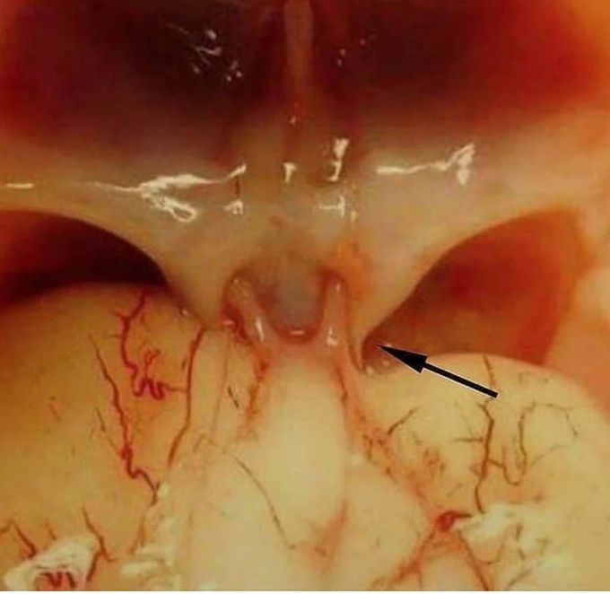 Optic Chiasm