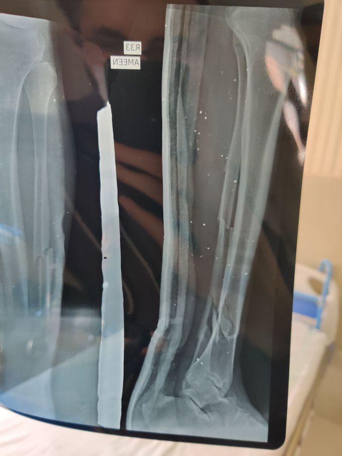 Tibia + Fibula fracture