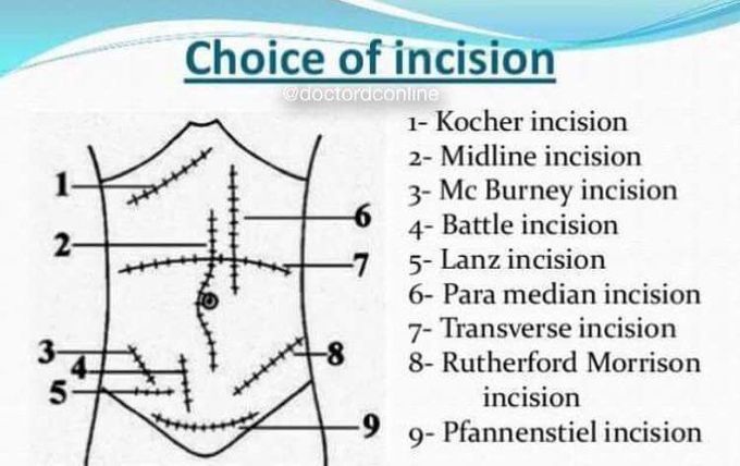 Incision