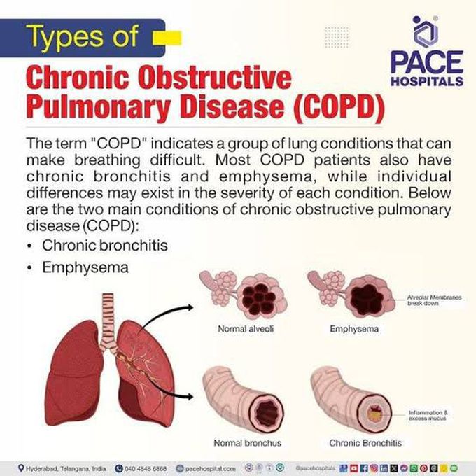 Chronic Obstructive Pulmonary Disease III