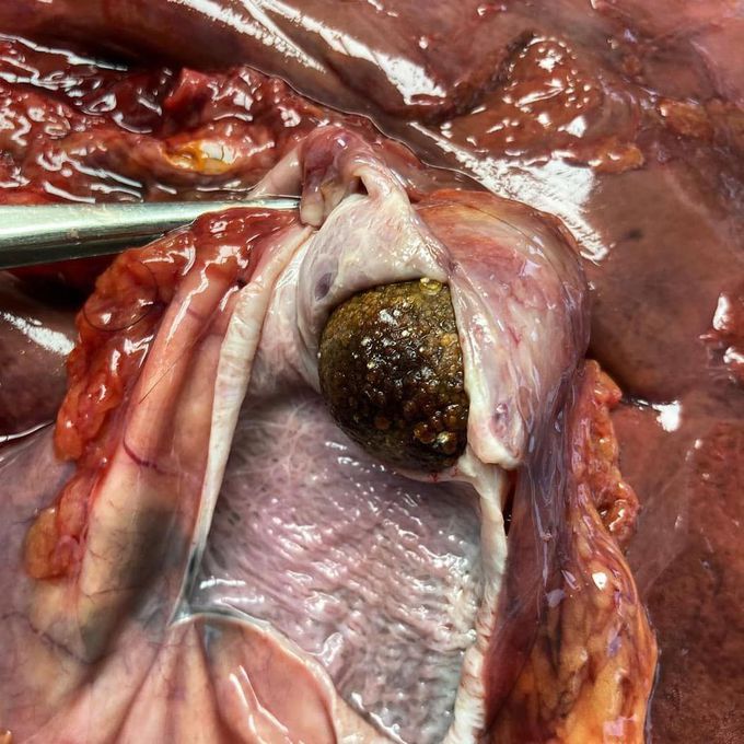 Gallstone wedged in the neck of gallbladder and cystic duct