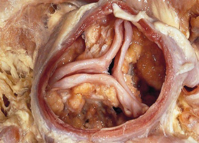 Aortic valve calcification