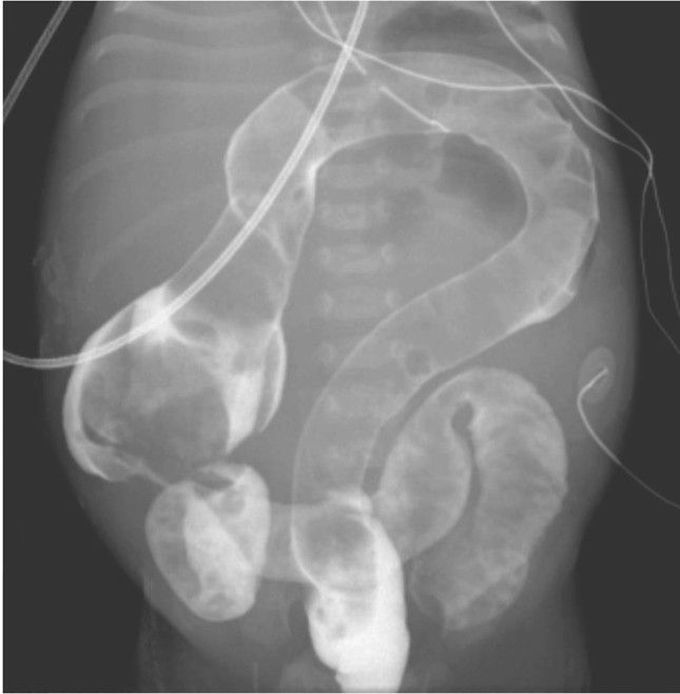 Question-Mark Appearance of the Colon