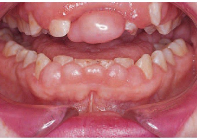 Drug induced gingival hyperplasia