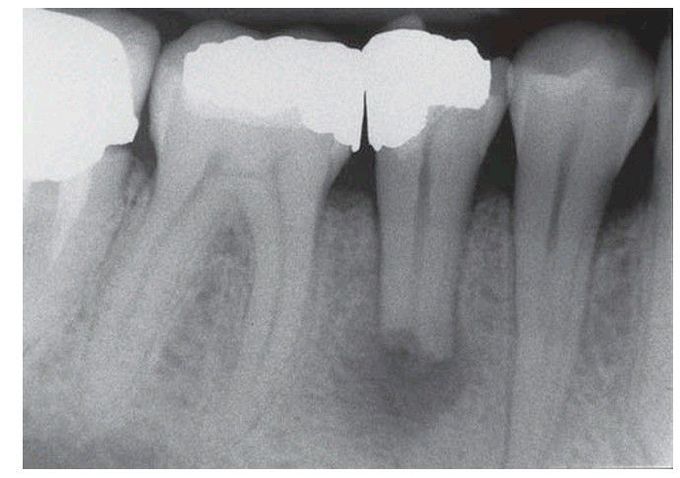 Root resorption