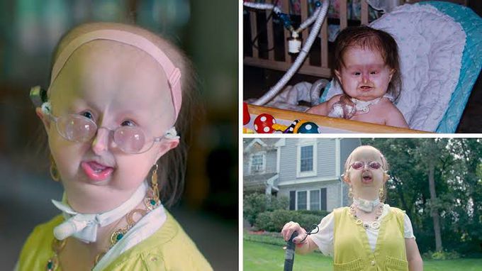 Rare syndrome known as hallerman streiff syndrome is a congenital disorderthat effects growth ,cranial development,hair growth &dental development less than 200 peoples in the world. Have this syndrome the cause of this disease is unknown Treatment. Treatment of Hallermann-Streiff syndrome (HSS) is based on the symptoms. Surgery is often necessary for the eye, head and facial features. Children with HSS also often need regular dental and orthodontic care