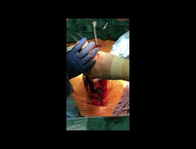 Sternotomy Closure