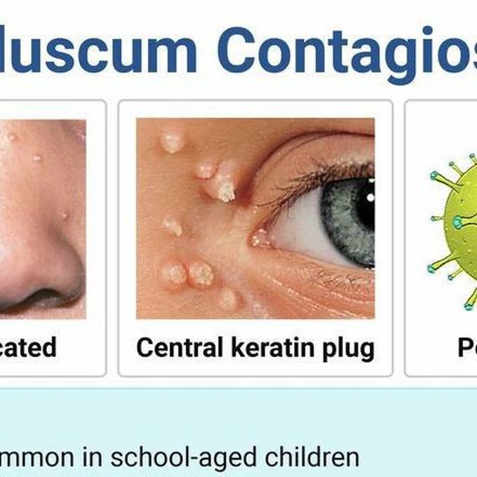 Moluscum