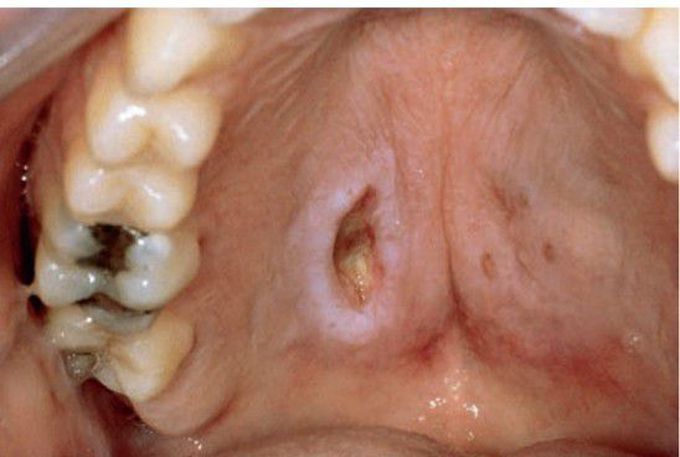 Neutrotizing sialometaplasia