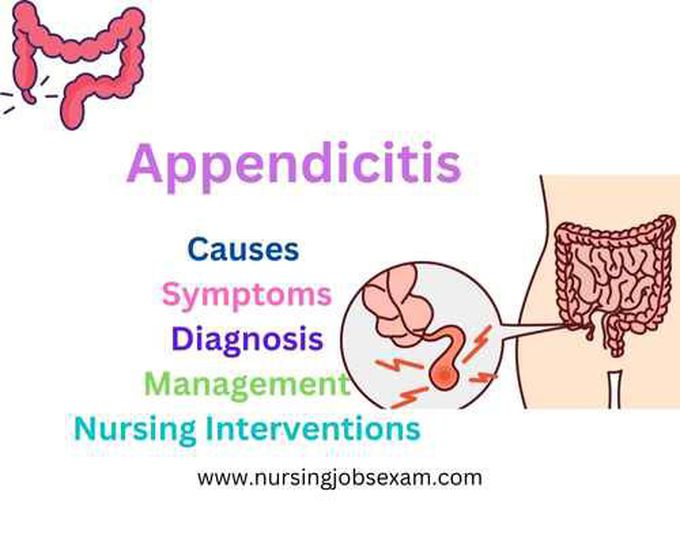 Appendicitis: Causes, Symptoms, Diagnosis, Management, Nursing Interventions - Nursing Jobs Exam