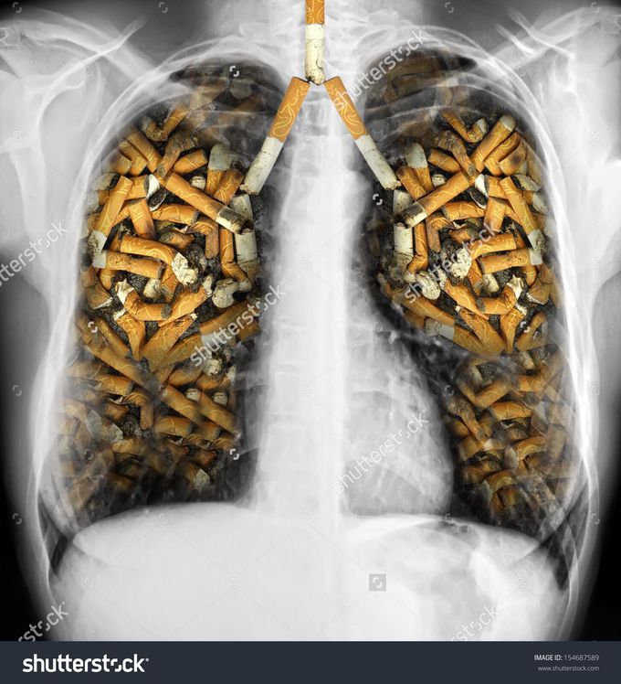 Lung cancer#cigarette smoking