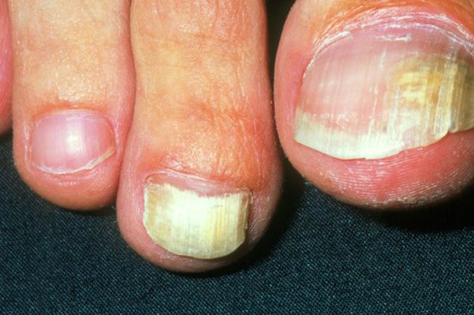 ONYCHOMYCOSIS