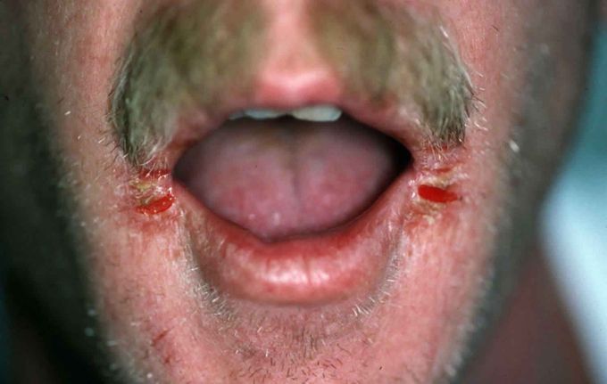 Causes of Angular Cheilitis