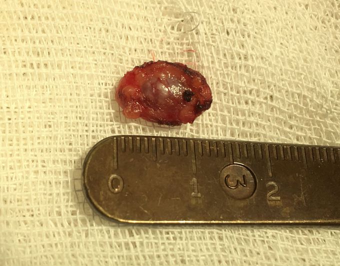 Precision technique for removing metastatic lymph node of the external jugular vein