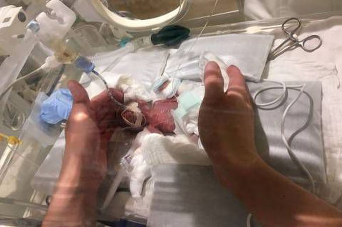 Unbelievable! Meet The Smallest Baby Boy Ever To Be Born Weighing Just 0.4kg (Photos)