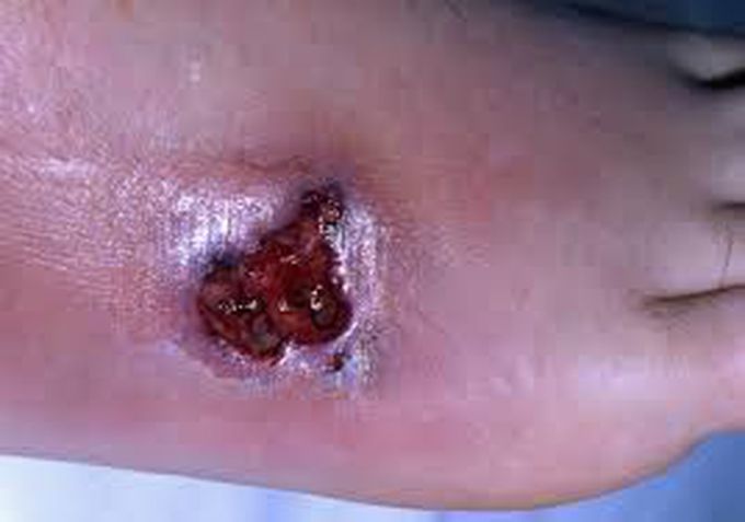 Pyoderma symptoms