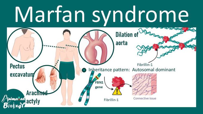 Marfan syndrome