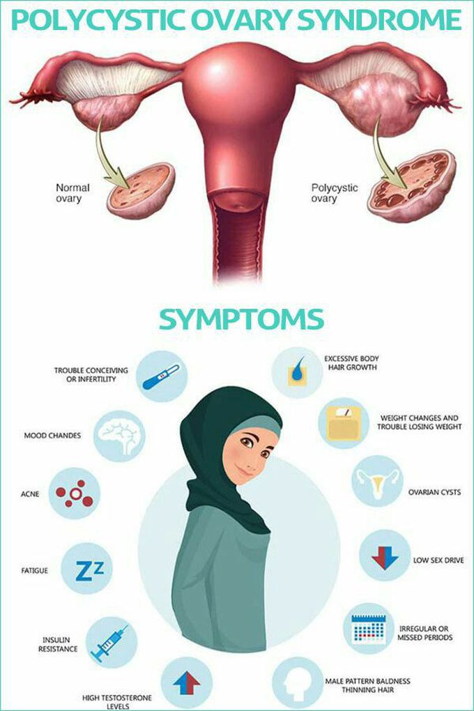 Polycystic ovar syndrome