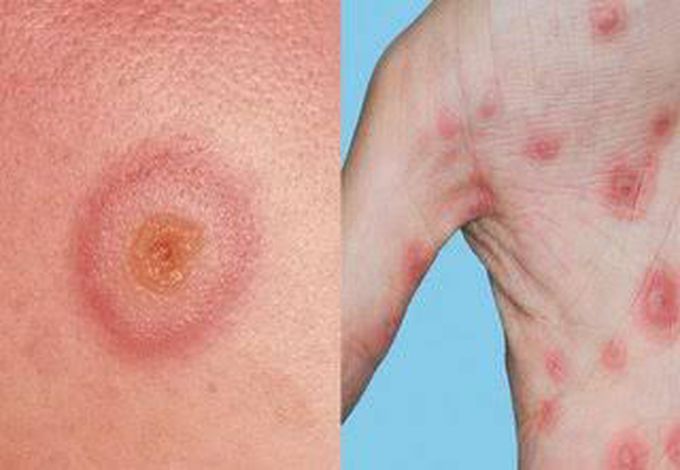 Symptomd of erythema multiforme